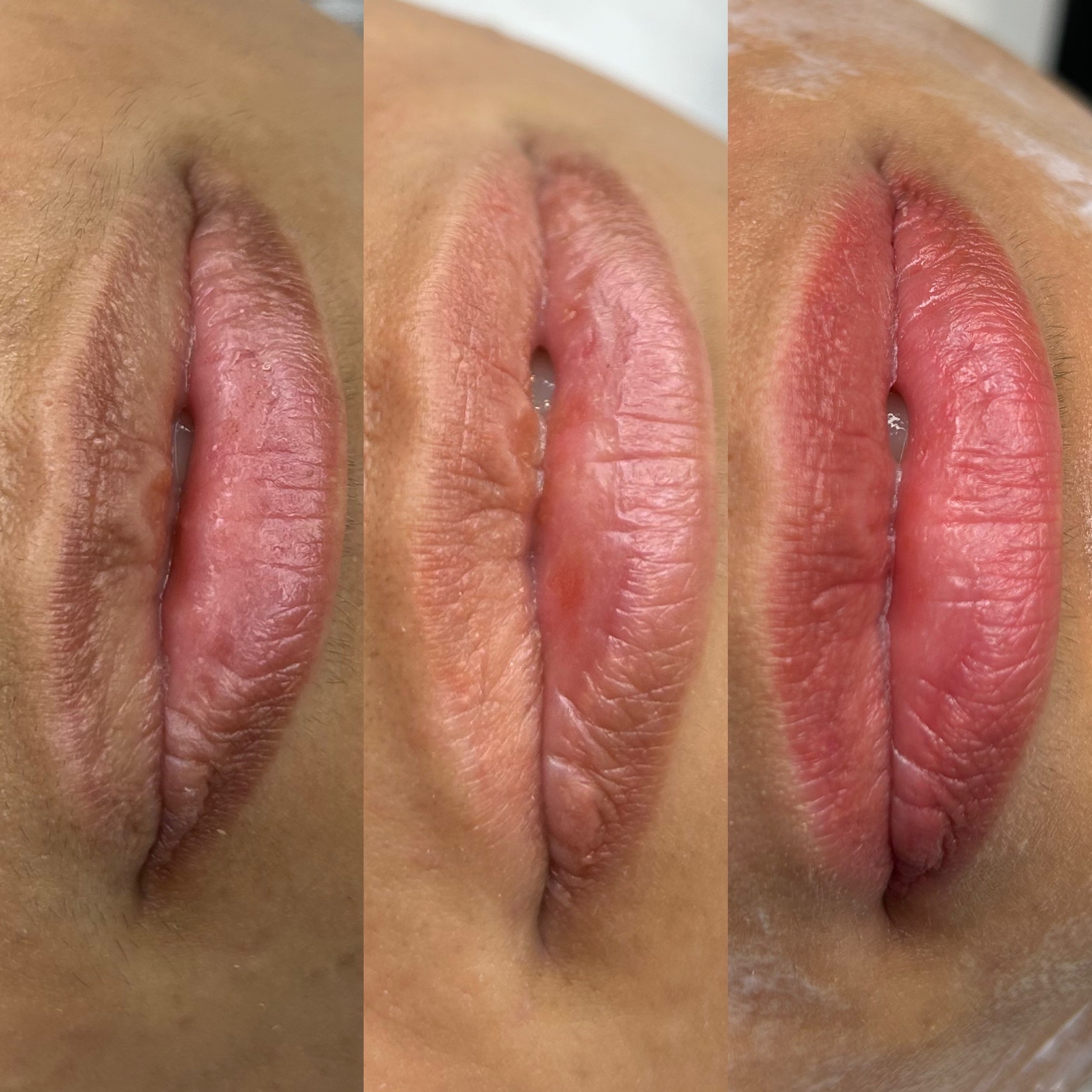 Dark Lip Neutralization at BISA PMU LLC in Plano, TX