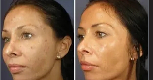 Dermaplan & Ultra PCA Chemical Peel