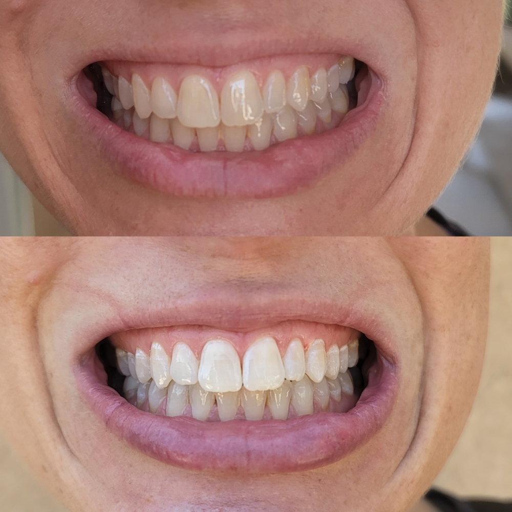 Teeth Whitening