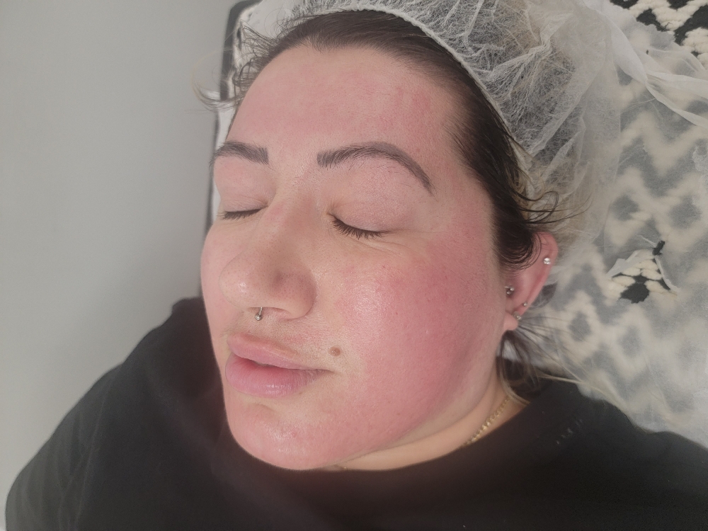 High Frequency Facial