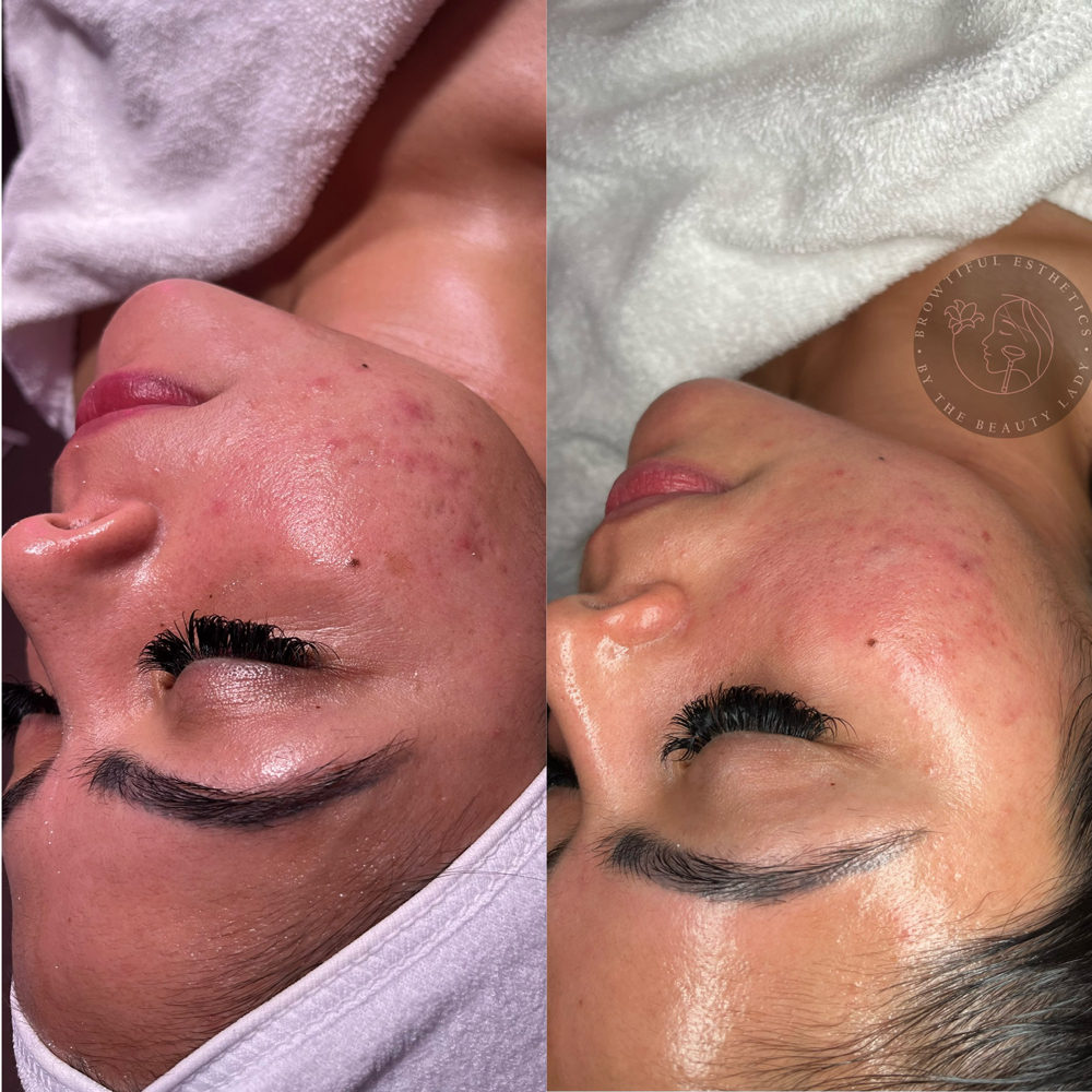 Acne Facial