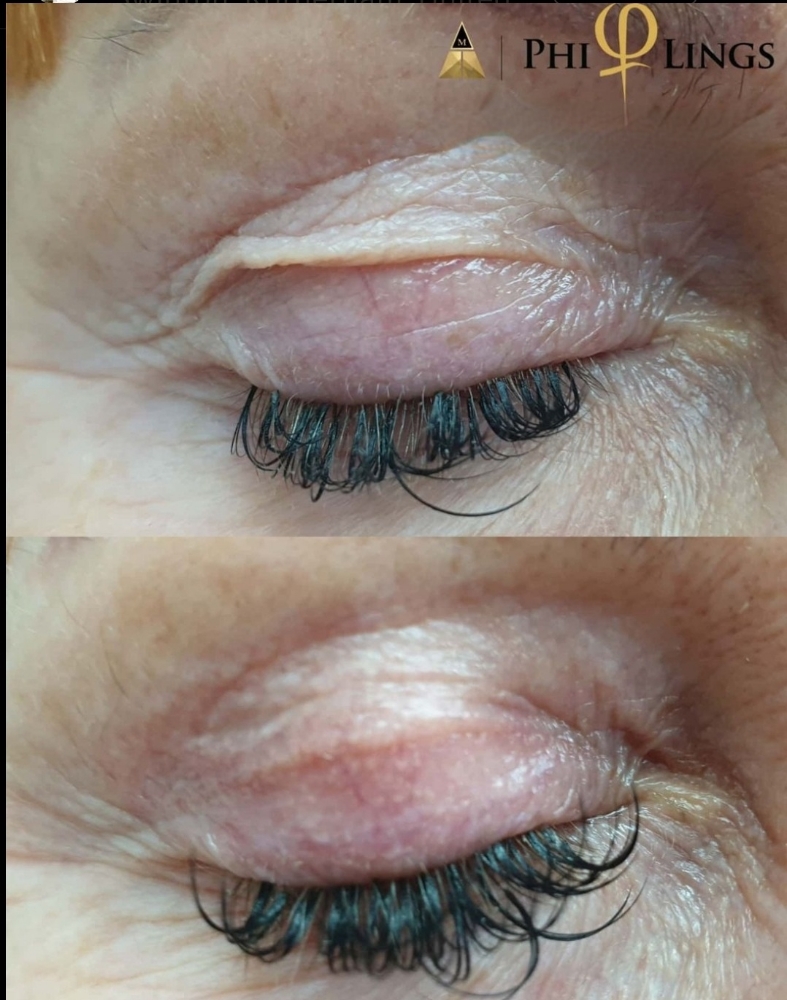 Fibroblast Upper Eyelift