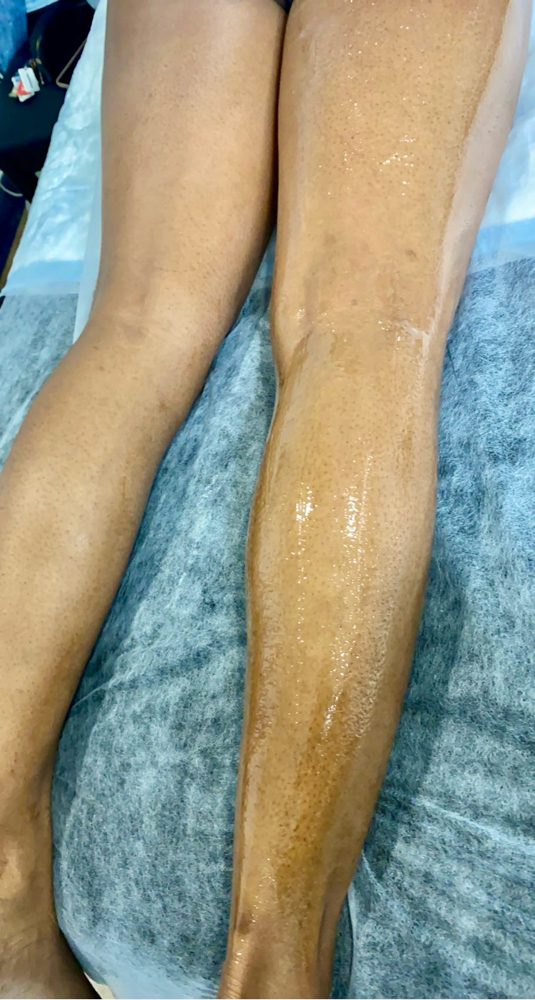 Sugaring - Full Legs