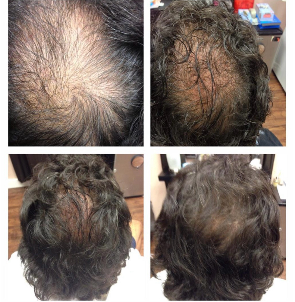 HOLISTIC HAIR LOSS TREATMENT