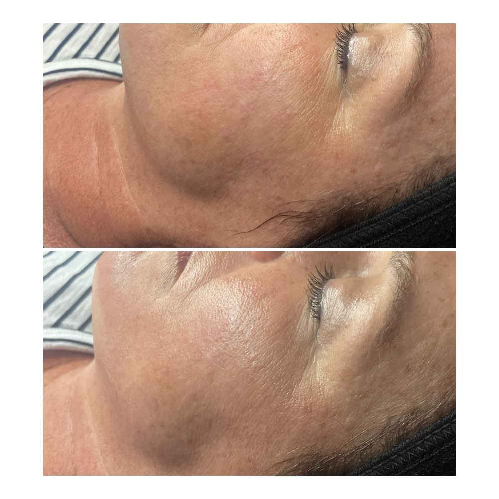 The Corrective Peel at The Skin Suite in Batesville, IN
