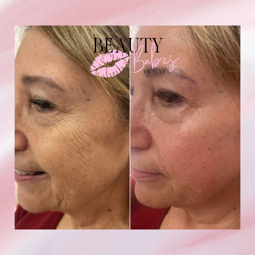Non-Surgical Face-Lift