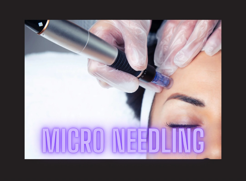 Microneedling