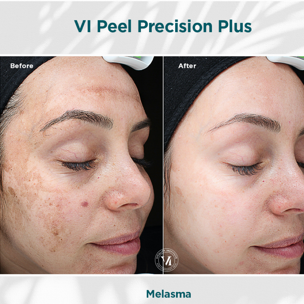 6 VI Peel® Chemical Peel Package at SKIN CLINIC in Laguna Hills, CA