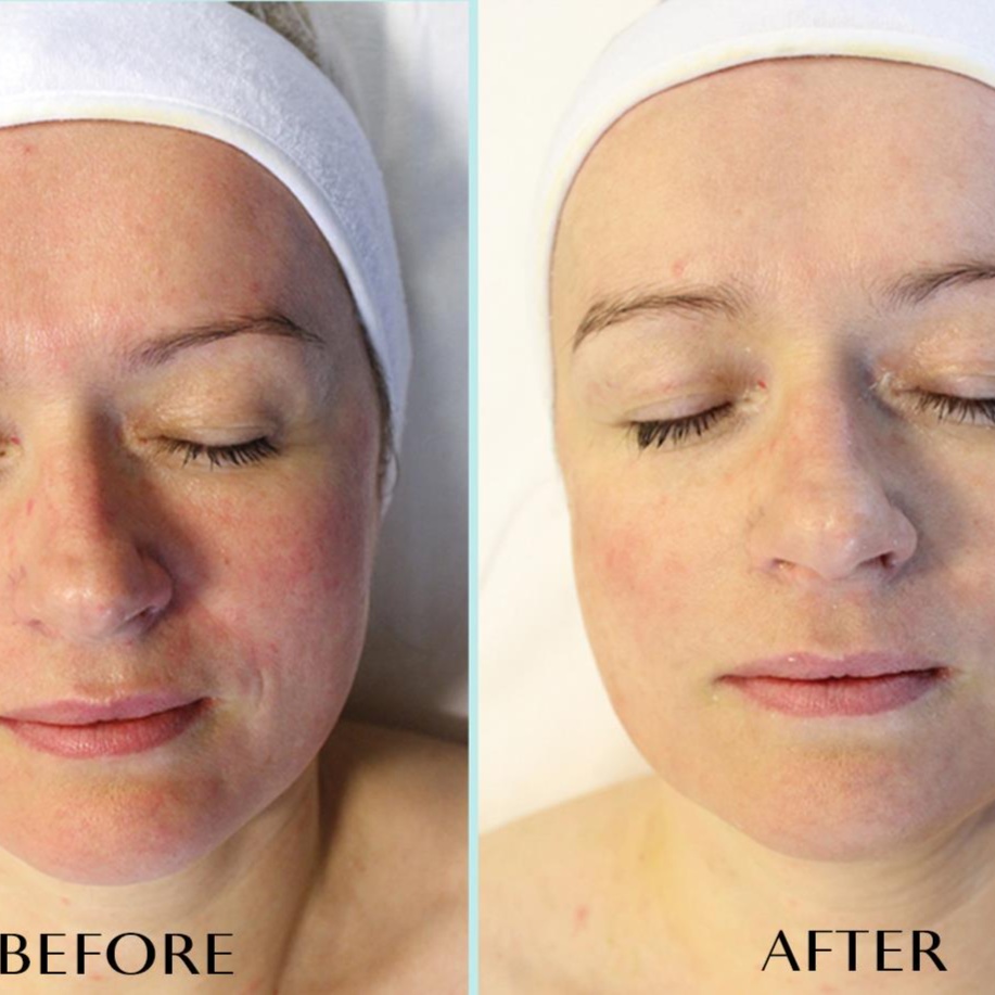 Reprechage Red-Out® Facial at NUyou Regenerative Medical Spa in Bartlesville, OK