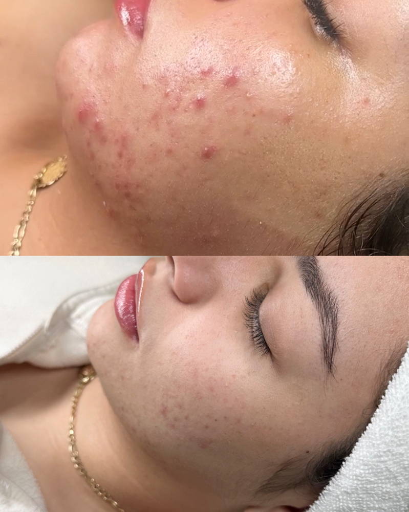 ACNE BOOTCAMP FACIAL