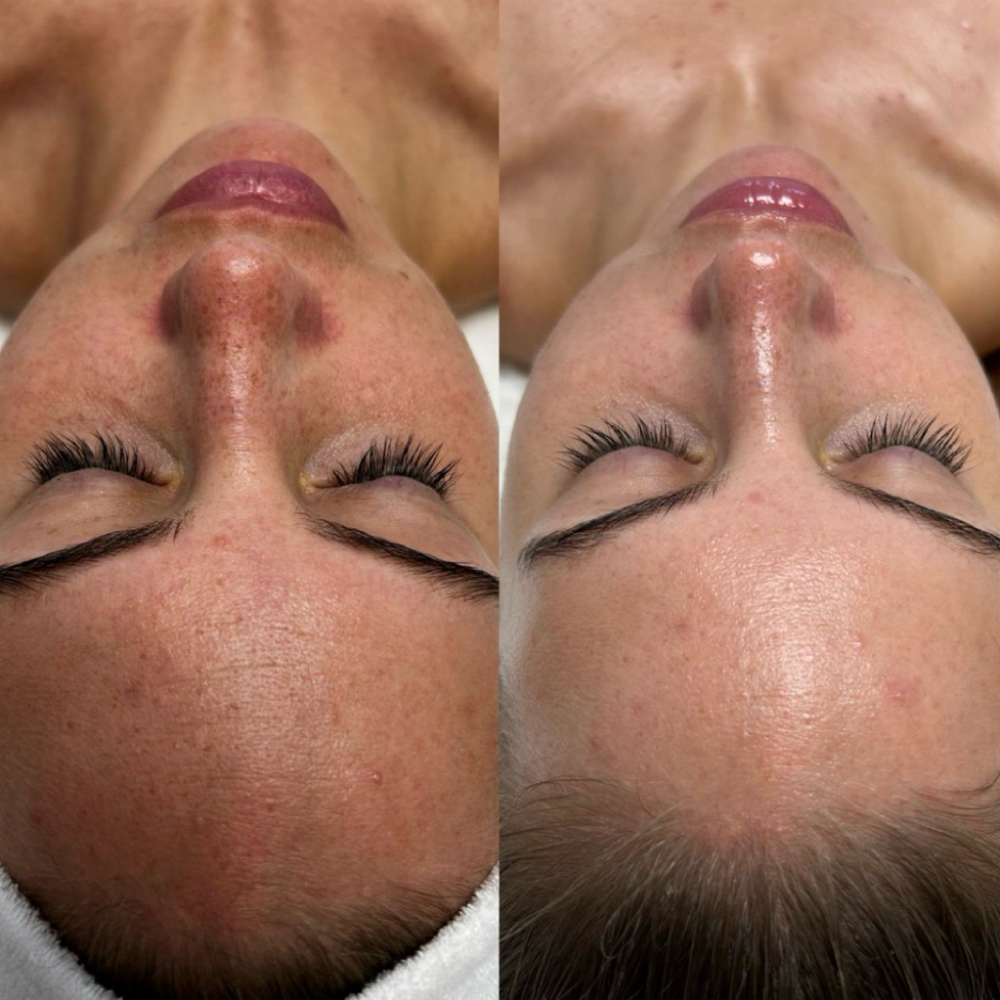 Hydrafacial at Prism Beauty in San Juan Capistrano, CA