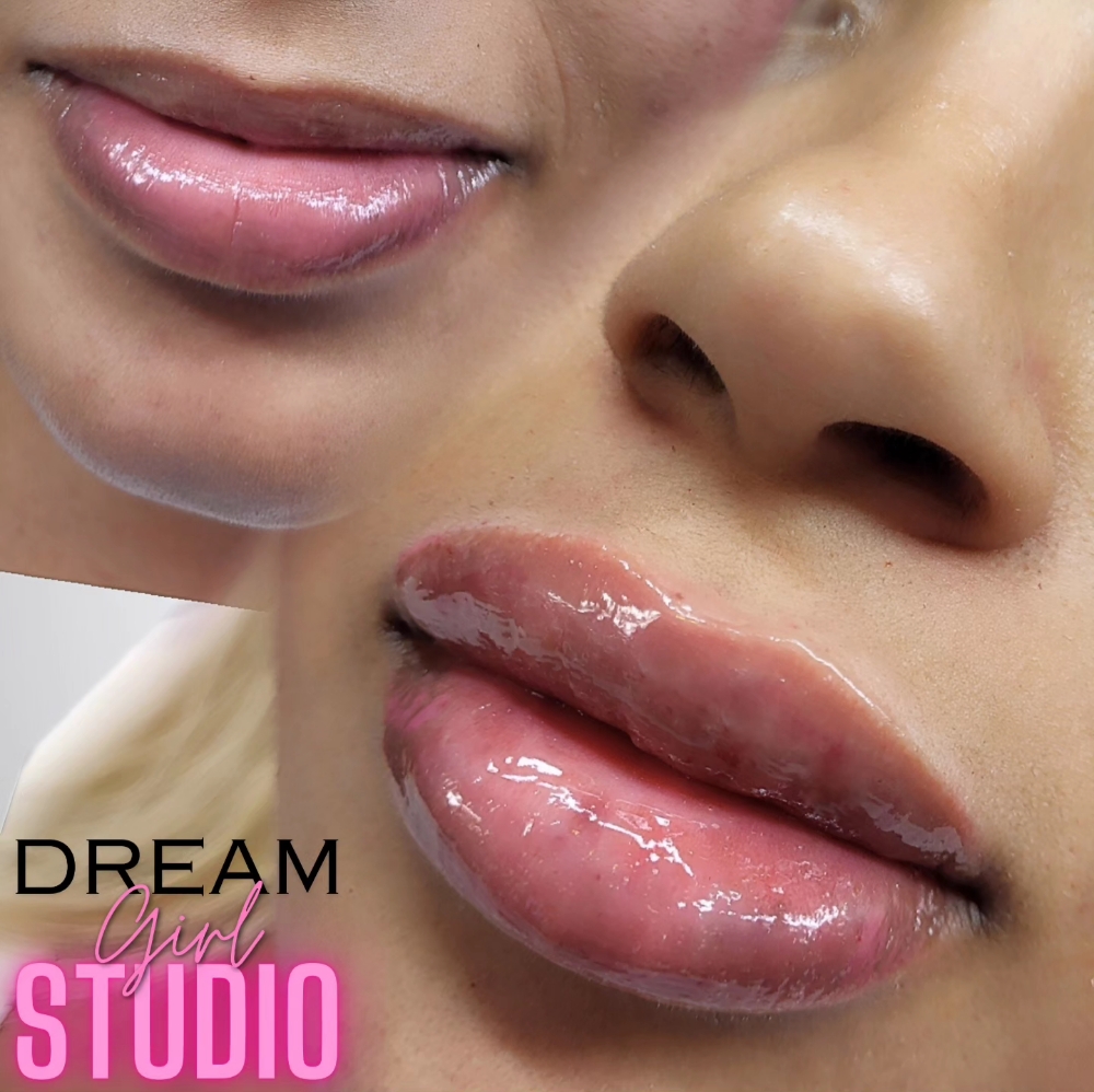 1.5ML Lip Filler