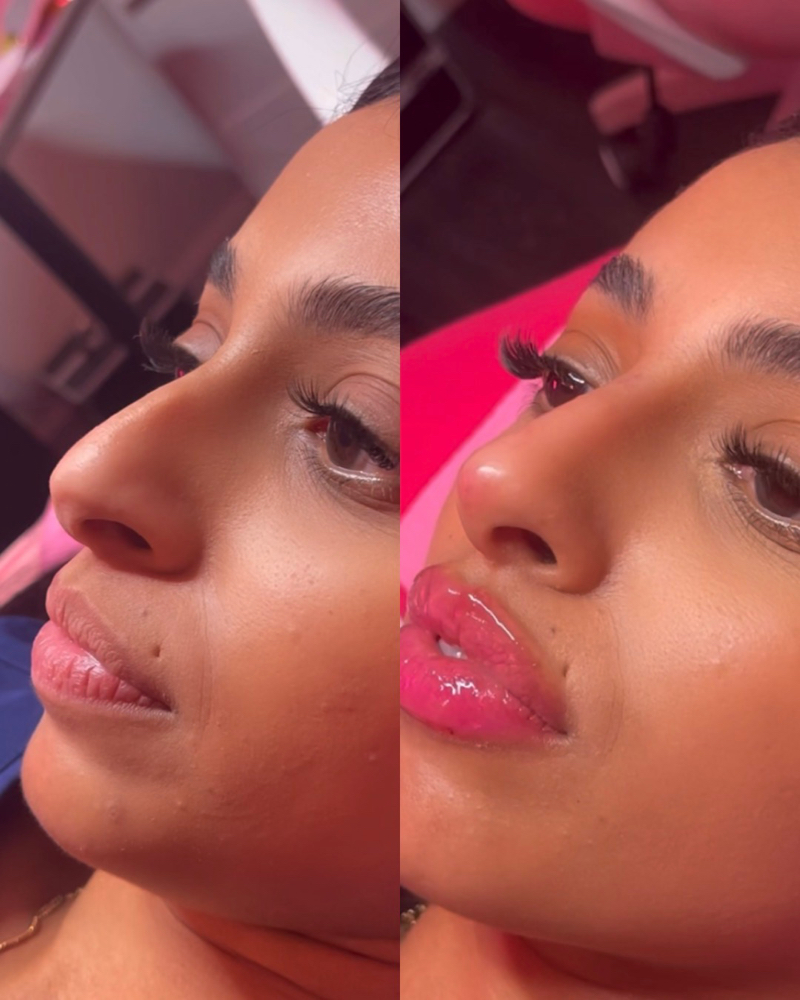 Nose Contour/Lift