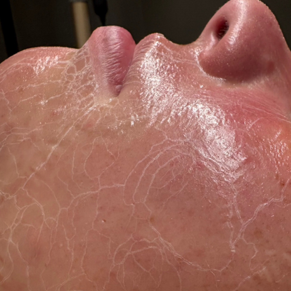Faux-TOX Facial at Pure Elegance Esthetics in North Andover, MA