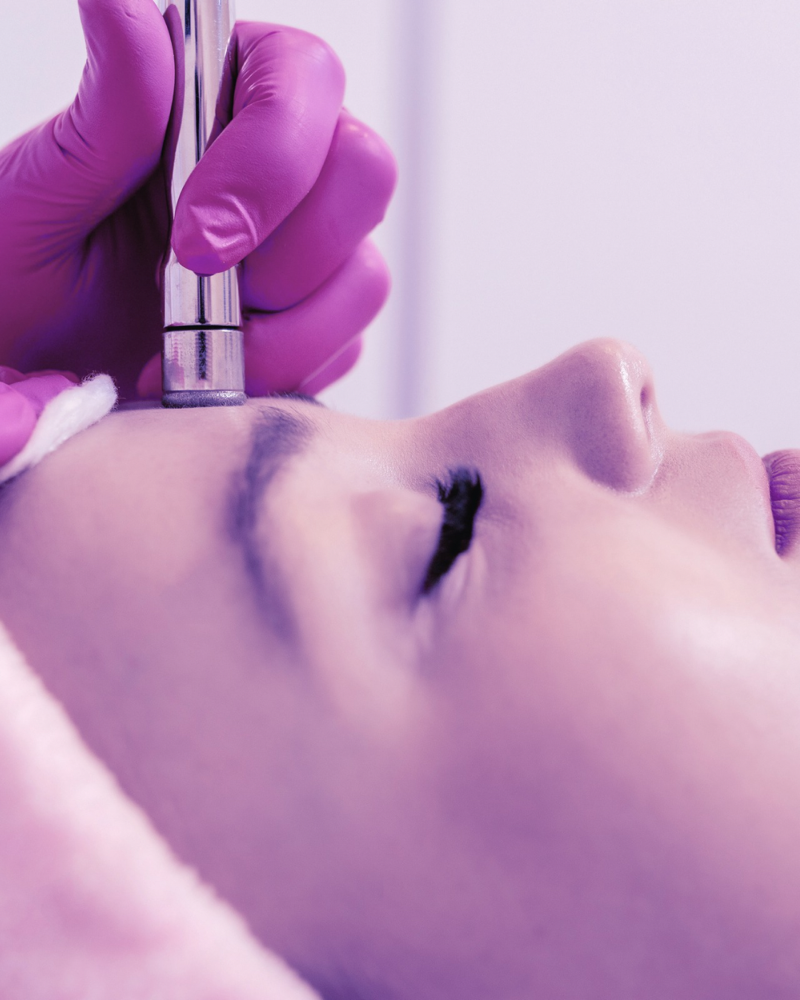 Microdermabrasion