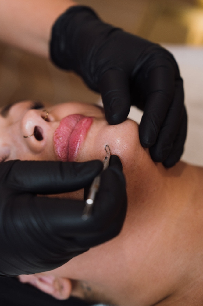 Acne Correction Treatment
