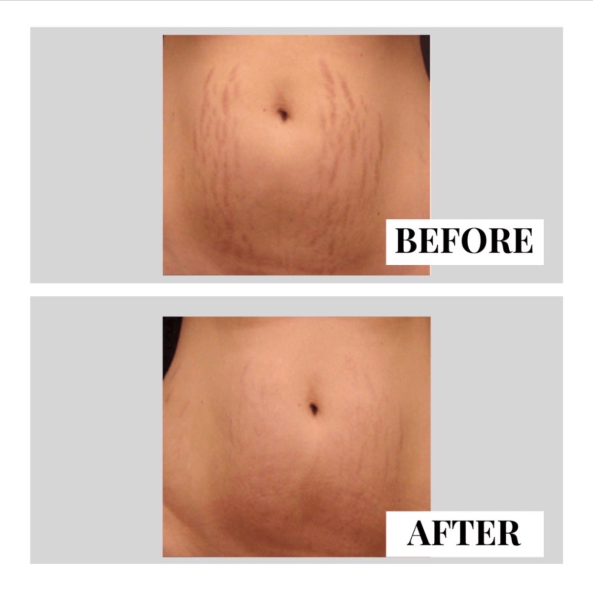 BODY RENEWAL | MICRONEEDLING at LEXTHETICS | Powered by Smiley Aesthetics & Dr. Katrina Briggs, MD in Columbus, OH