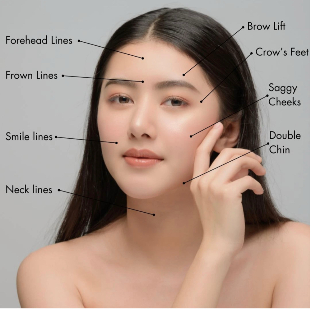 BOTOX - Wringle Free Treatment