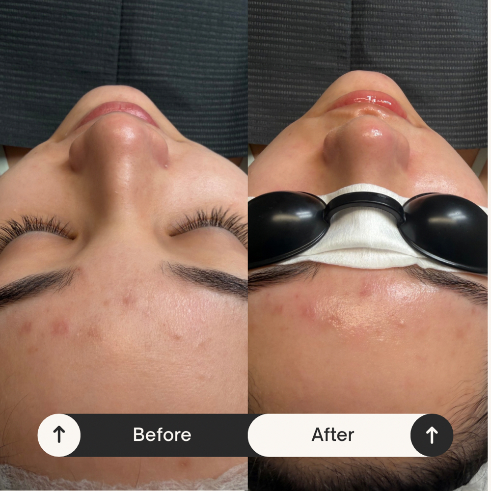 Microneedling With HA at Mily Aesthetics in Newark, NJ