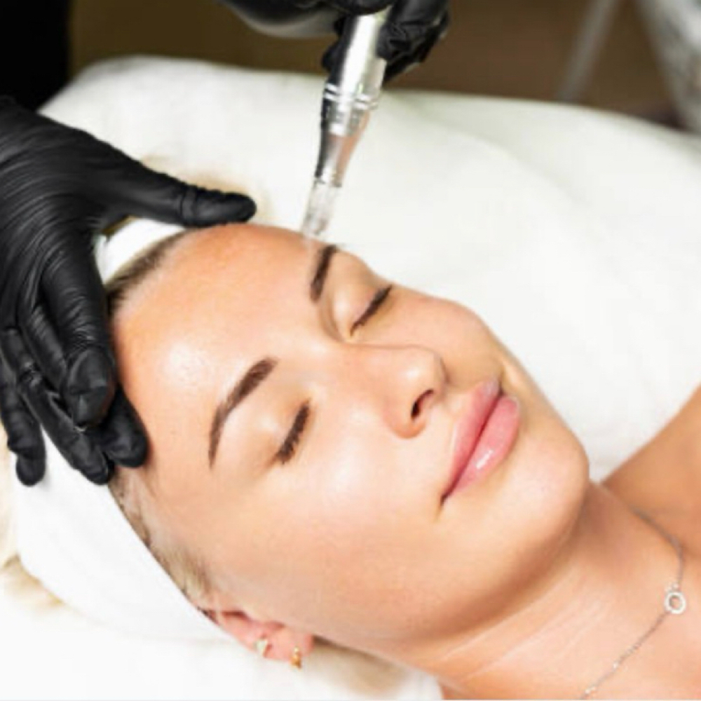 Microneedling Consult at SCL Aesthetics in Putnam, CT