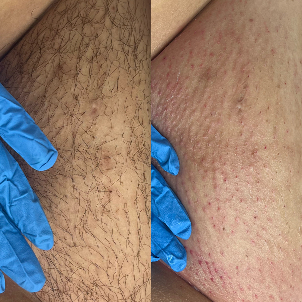 Extended Brazilian Wax