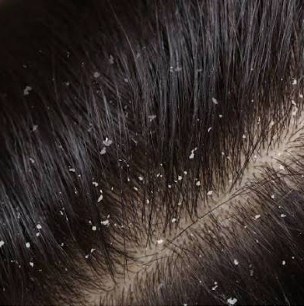 Scalp Detox at Drstrandz in Missouri City, TX