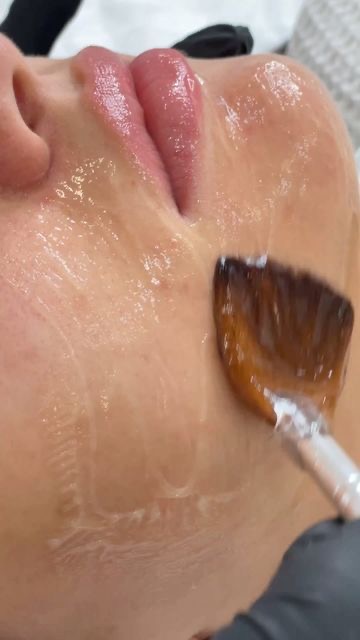 The Chemical Peel at beautybylinnaea in Overland Park, KS