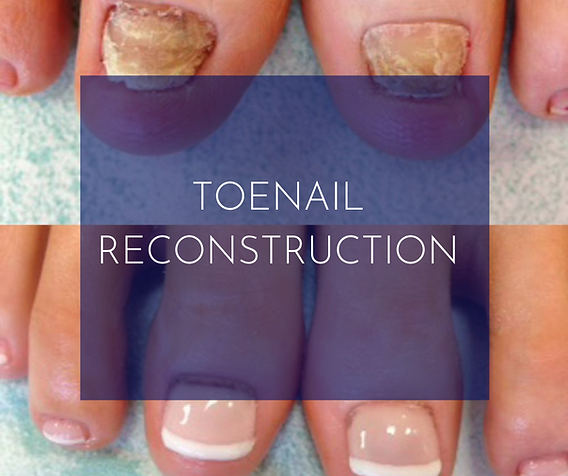 Prosthetic Toe Nail - Each Toe