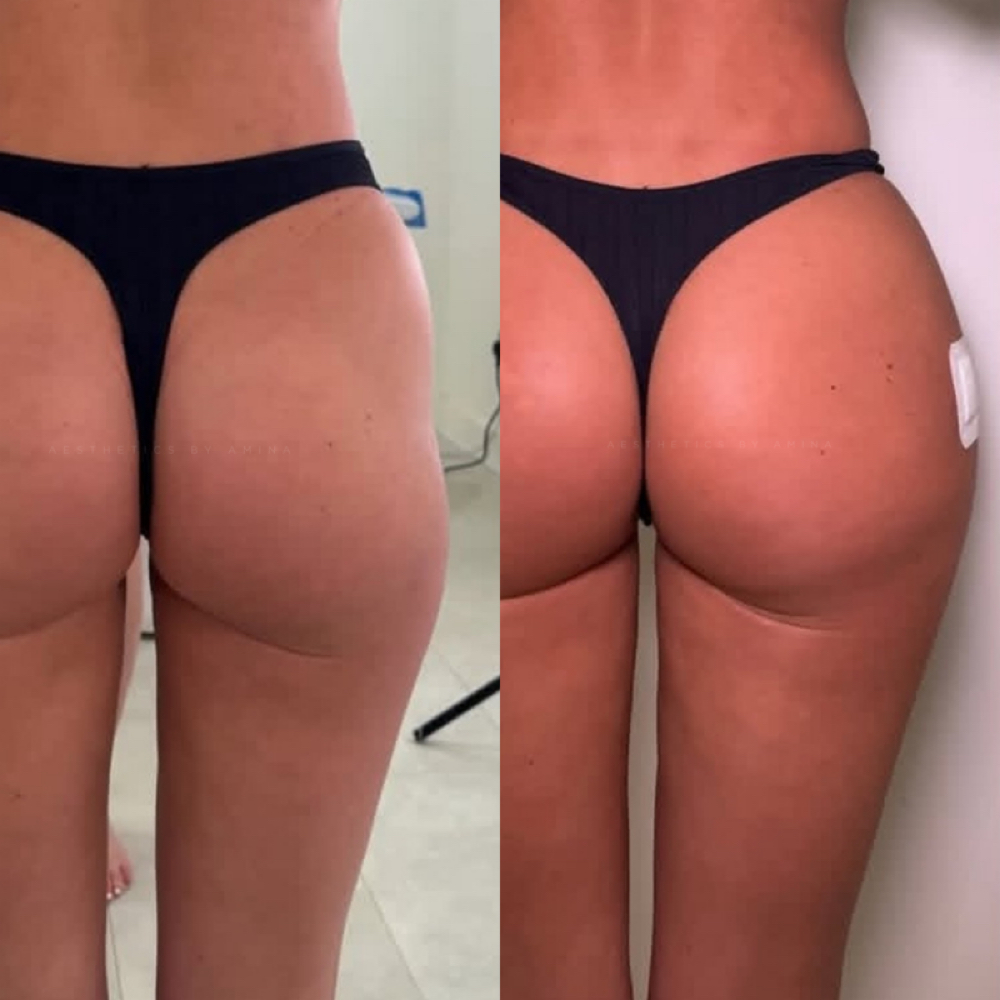 Liquid BBL at Aesthetics by Amina in New York, NY