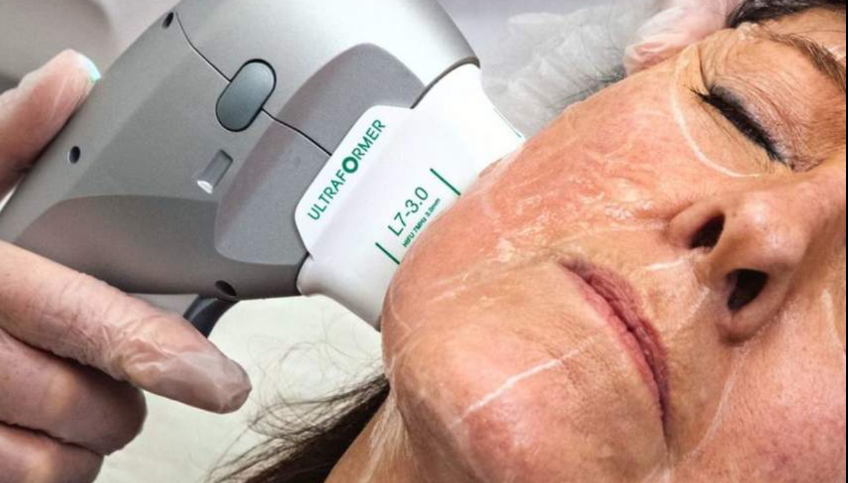 HIFU Non‑Surgical Face Lift