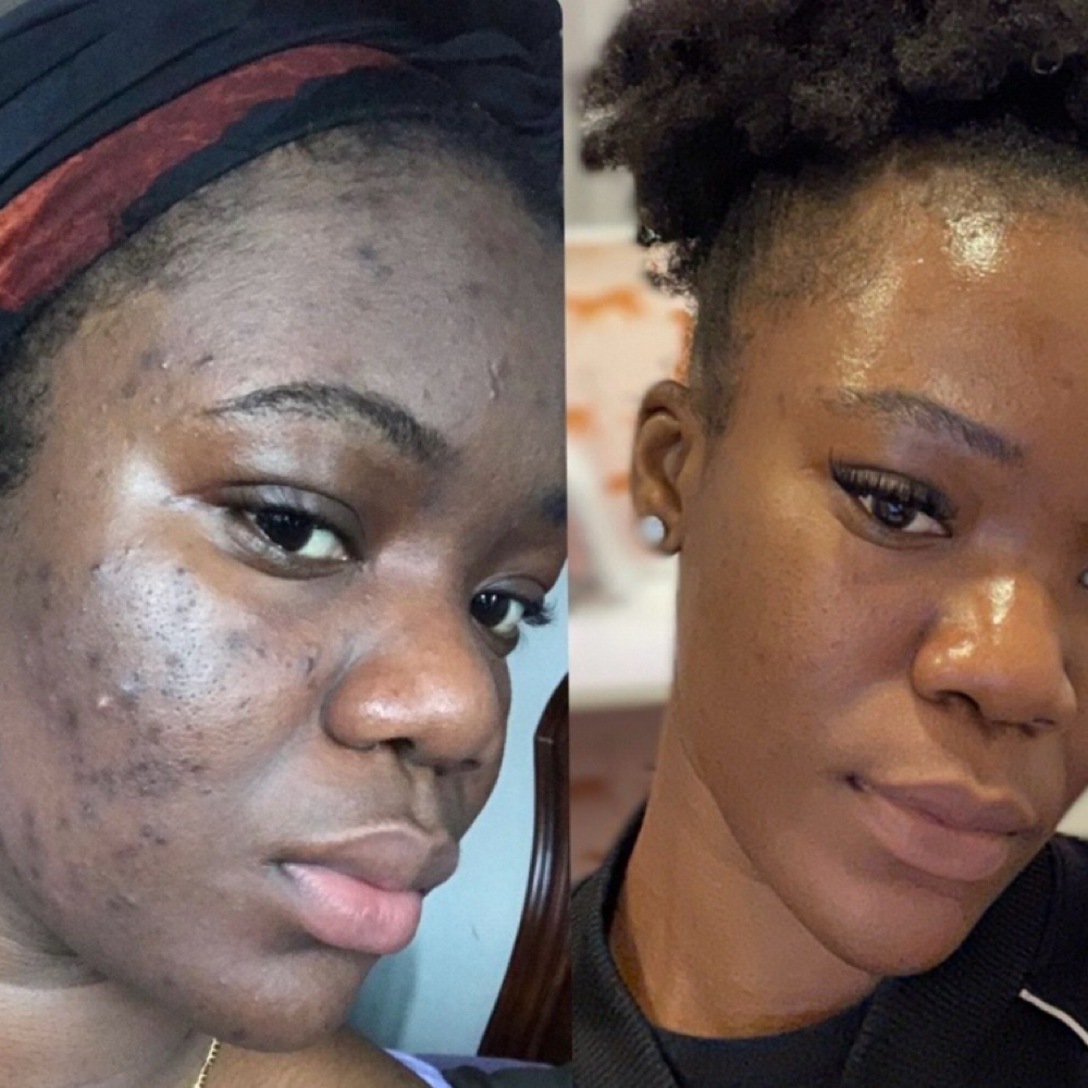 Designer Peel for Deeper Skin Tones at Glow & Behold in Durham, NC