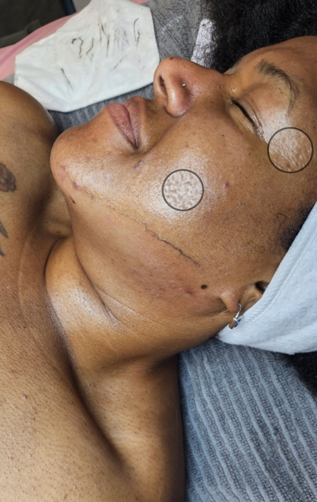 Dermaplaning