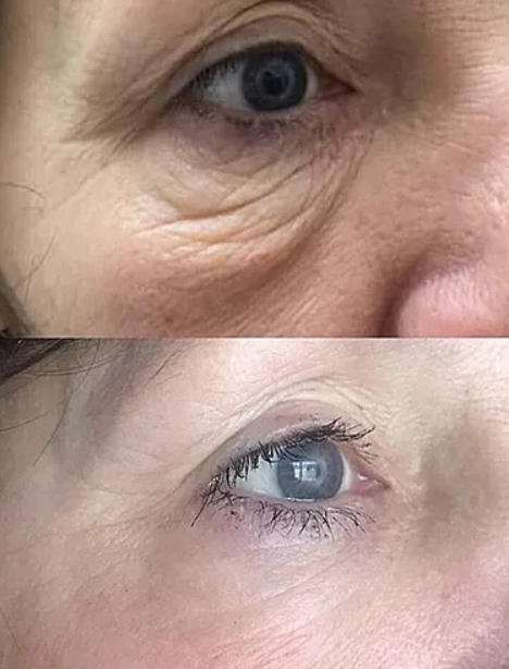 Fibroblast Under Eyes