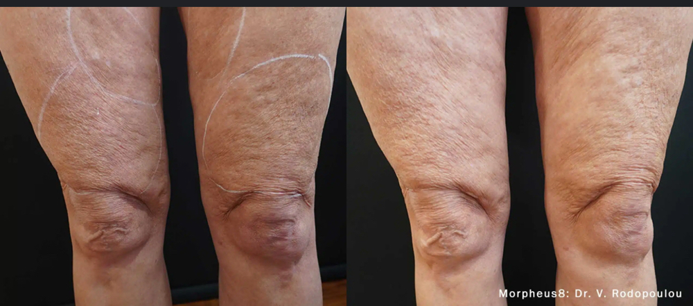 Morpheus Body (small Area)