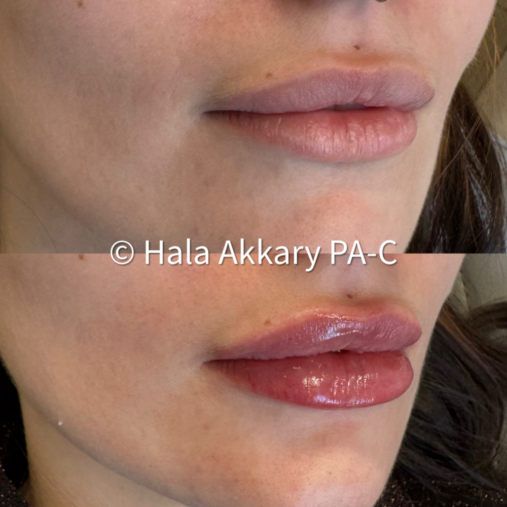 Lip Filler at Revive Aesthetics Medical Spa in Oklahoma City, OK