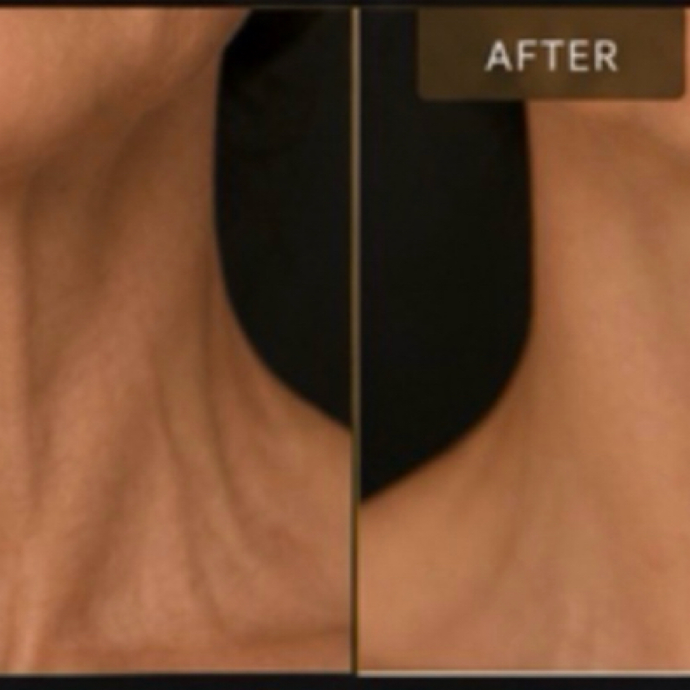Platysmal bands (Neck) at AK Aesthetics & Wellness LLC in Alice, TX