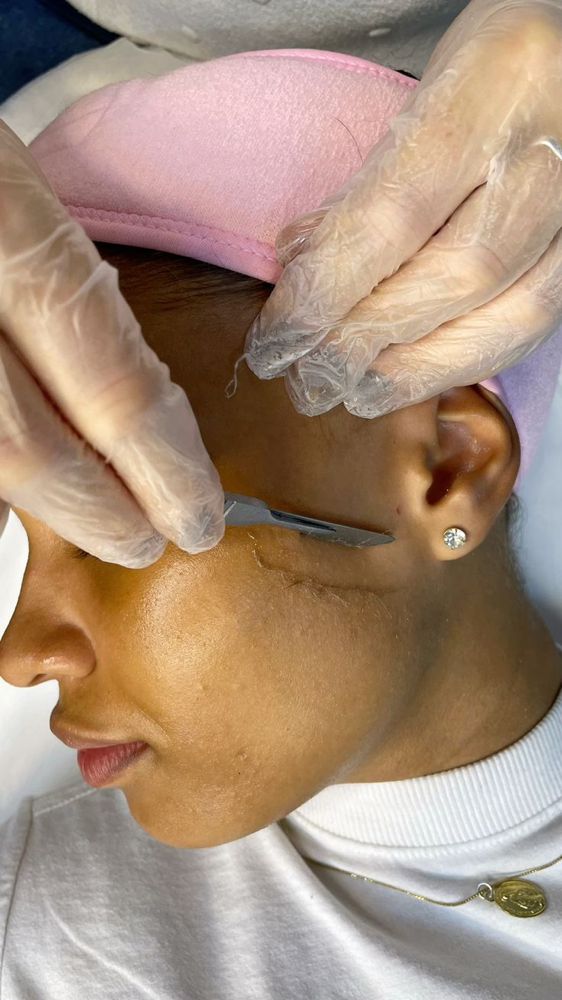 DERMAPLANING
