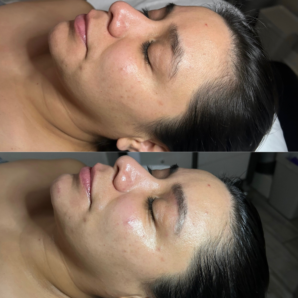 Vivid Microderm Facial