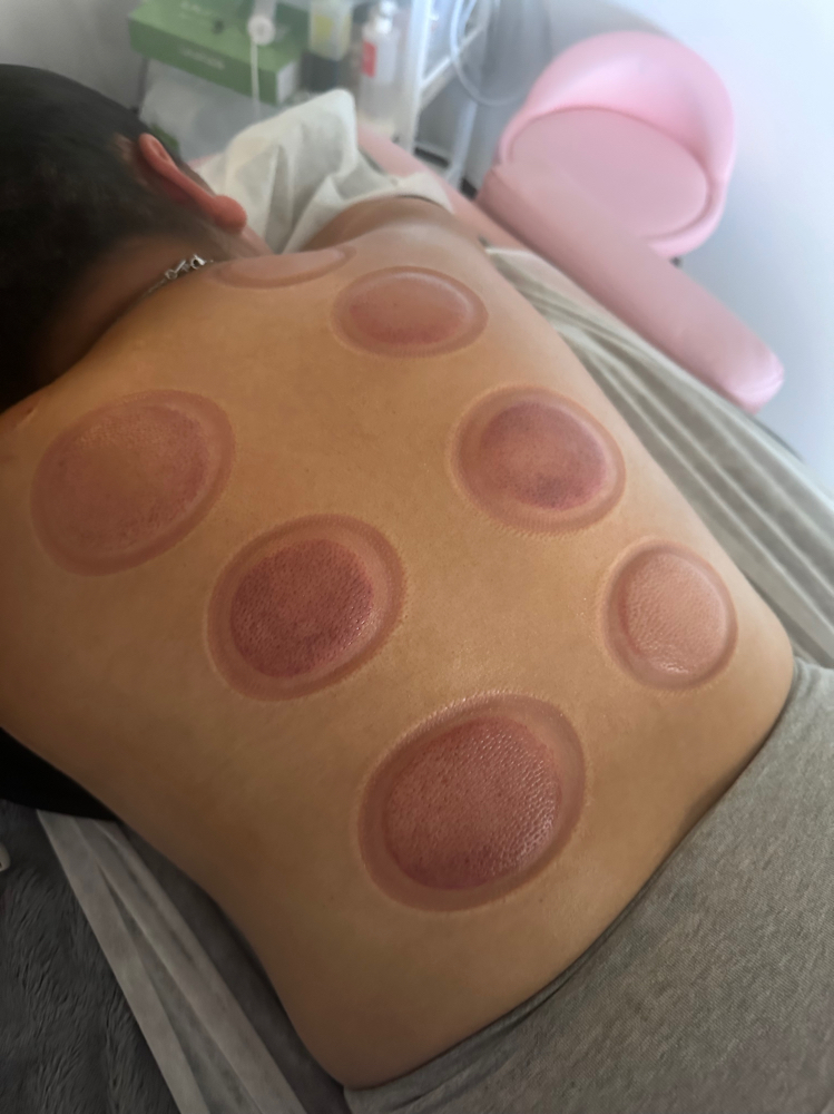 Cupping Therapy at Sayda Franco Health and Wellness in Bloomingdale, IL