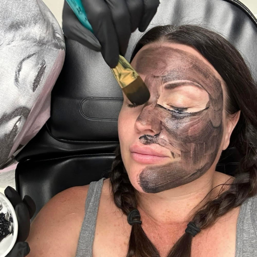 Carbon Peel at ARock Beauty & Wellness in San Angelo, TX