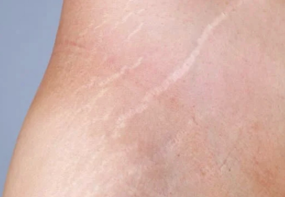 Stretch Mark Camouflage