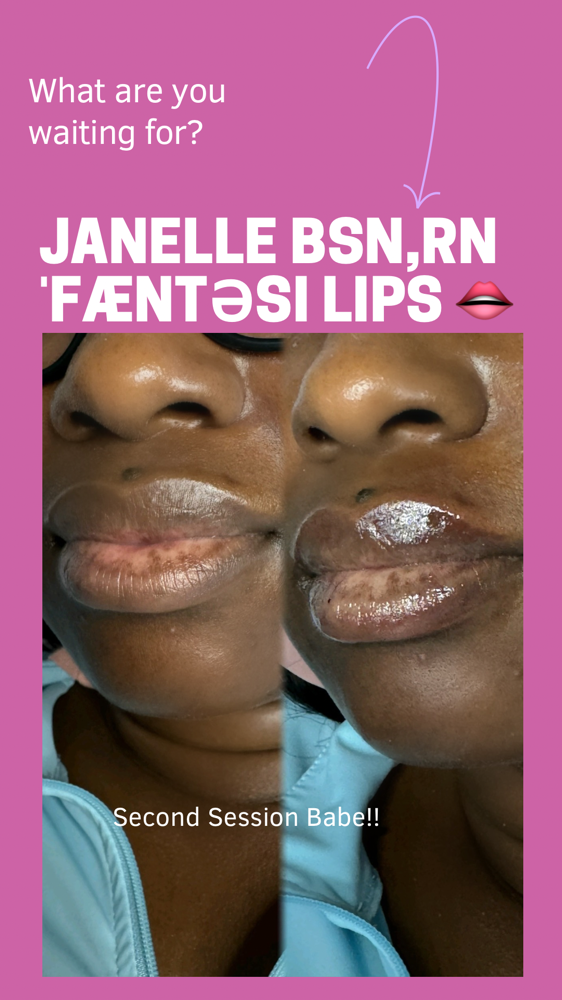 1.5 ML FILLERS at ˈFæntəsi Lips 👄 in Lewisville, TX