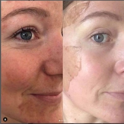 Skin Renewal Treatment