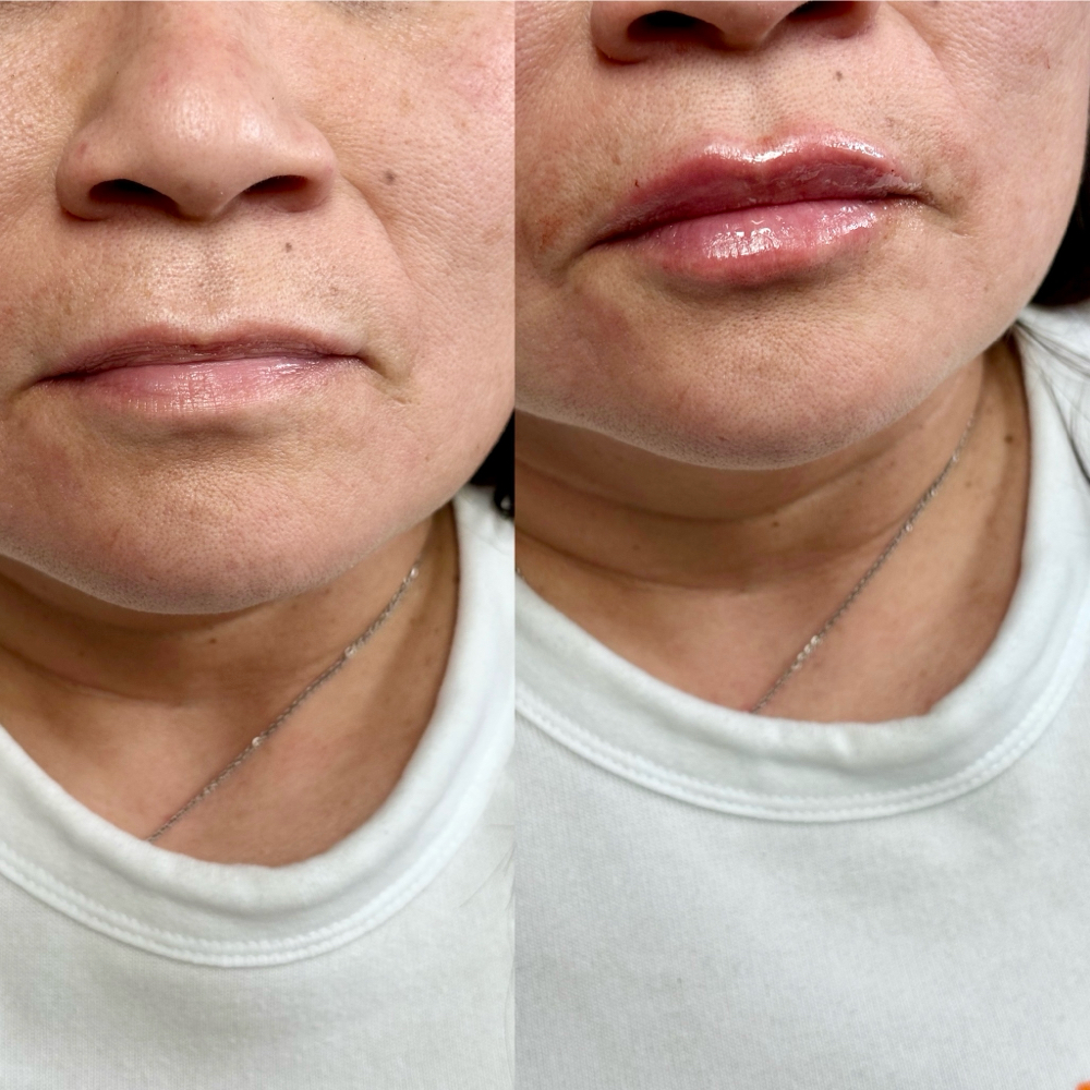 Lip Filler