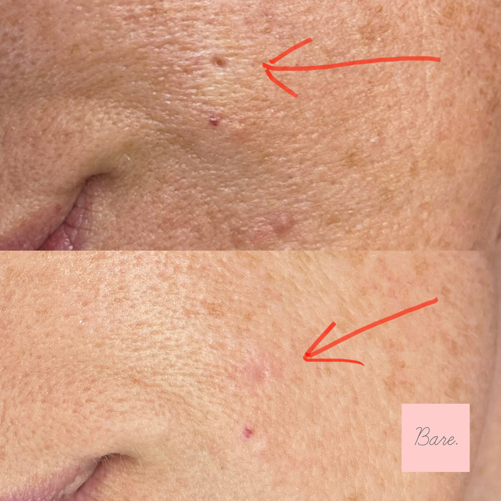 Microneedling