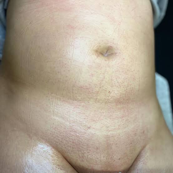 Stomach Strip