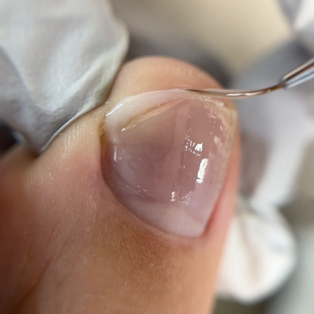 Foot Nail Repair at Rosestudiobykarol in Miami, FL