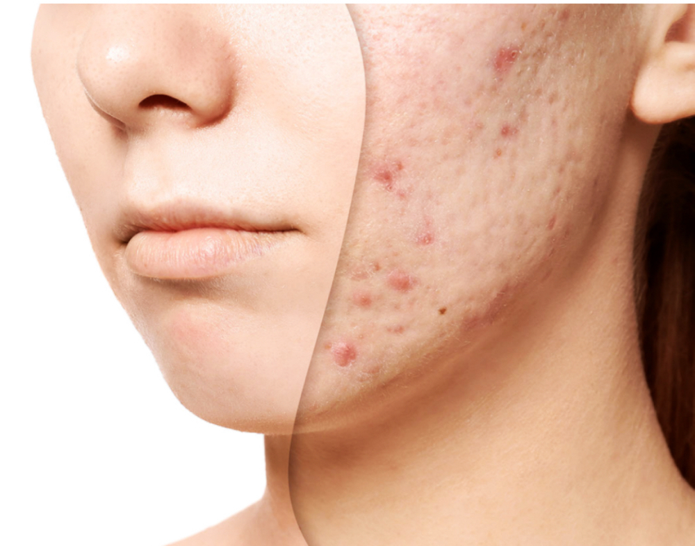 Clear Skin Peel Facial