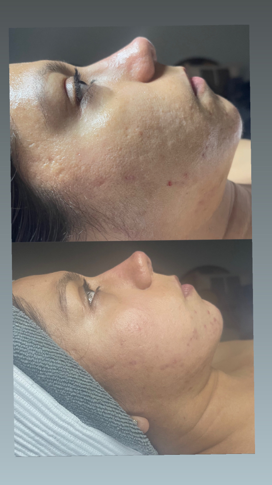 Microneedling