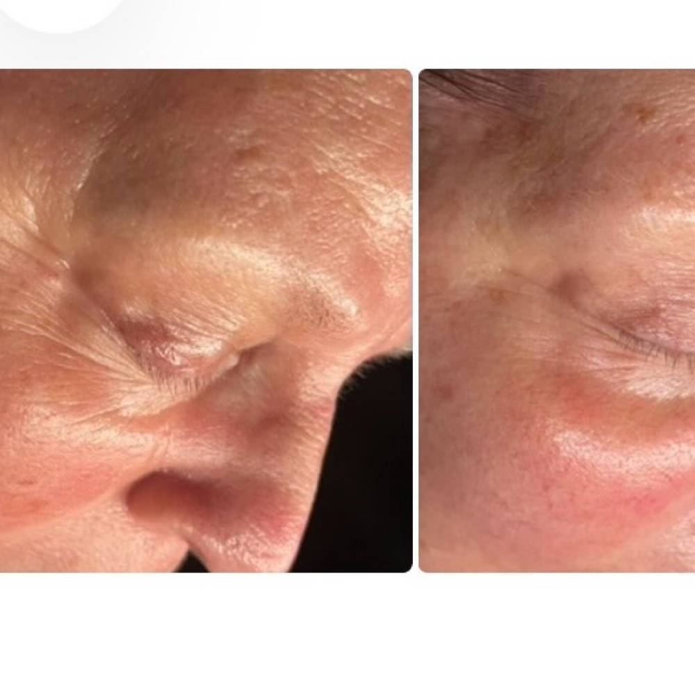 Lunar Lift Facial at MOONSTONE AESTHETICS in Fayetteville, AR